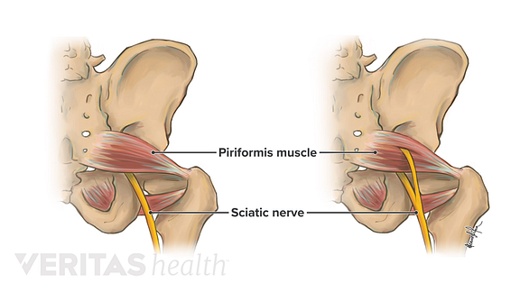 The sciatic nerve is usually undivided and leaves the pelvis through the greater sciatic foramen below the piriformis muscle (left). Sometimes, the nerve may be divided, with one part passing through the piriformis and the other below the muscle (right).